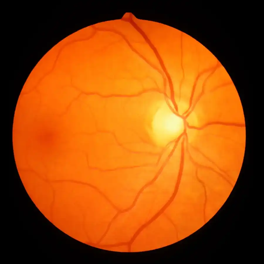 Retinal image used for diabetic eye exams in Syracuse, Utah